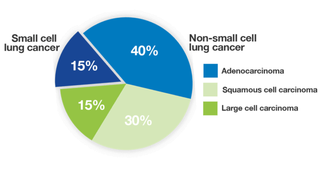 Pie chart that shows two main types of lung cancer and percentages of occurrence of each. Non-small cell lung cancer makes up 85% and includes adenocarcinoma, squamous cell carcinoma, and large cell carcinoma. The other 15% is small cell lung cancer.